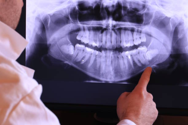 Best Emergency Wisdom Teeth Removal in Windcrest, TX